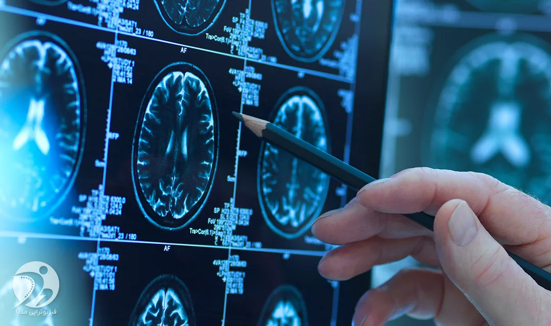 سکته مغزي چيست - علایم و درمان فیزیوتراپی